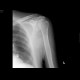Abruption of articular surface of humeral head, osteonecrosis: X-ray - Plain radiograph